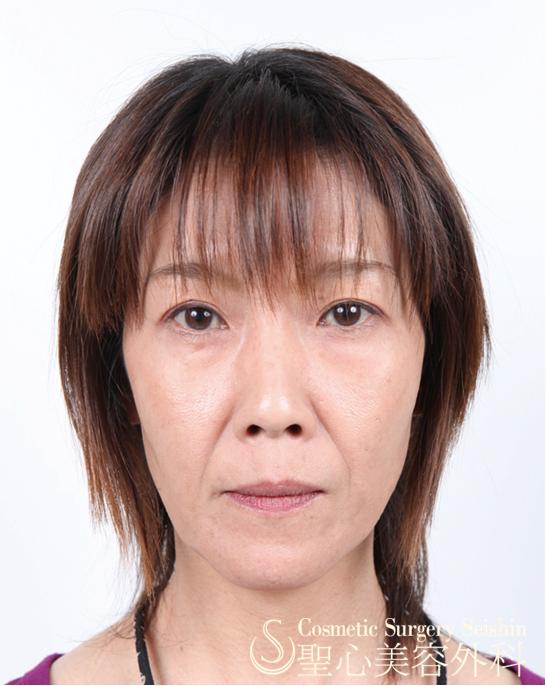 40代 目の下のたるみ ほうれい線 プレミアムprp皮膚再生療法 症例写真 美容整形 美容外科なら聖心美容クリニック