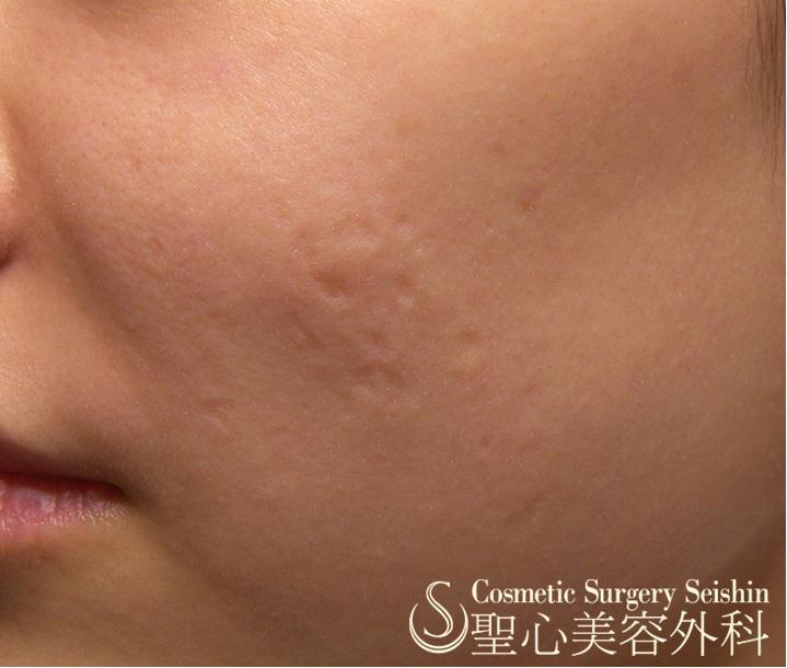 【20代女性：毛穴、ニキビ痕】イントラセル Before 