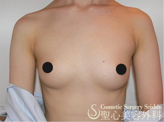 【20代：FTM（性同一性障害】乳腺切除術 Before 