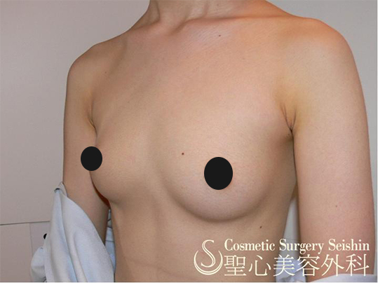 【20代：FTM（性同一性障害】乳腺切除術 Before 