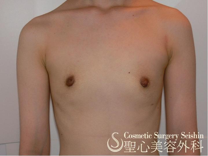 【20代：FTM（性同一性障害】乳腺切除術 After 