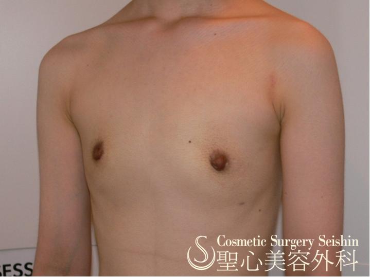 【20代：FTM（性同一性障害】乳腺切除術 After 