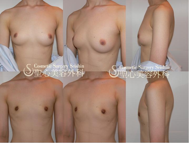 【20代：FTM（性同一性障害】乳腺切除術 After 
