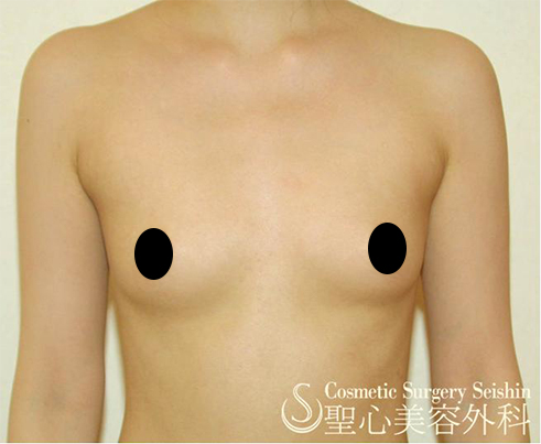 セリューション豊胸術　１年後 Before 