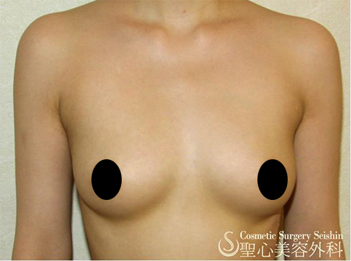 セリューション豊胸術　１年後 After 