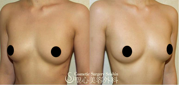 セリューション豊胸術　１年後 After 
