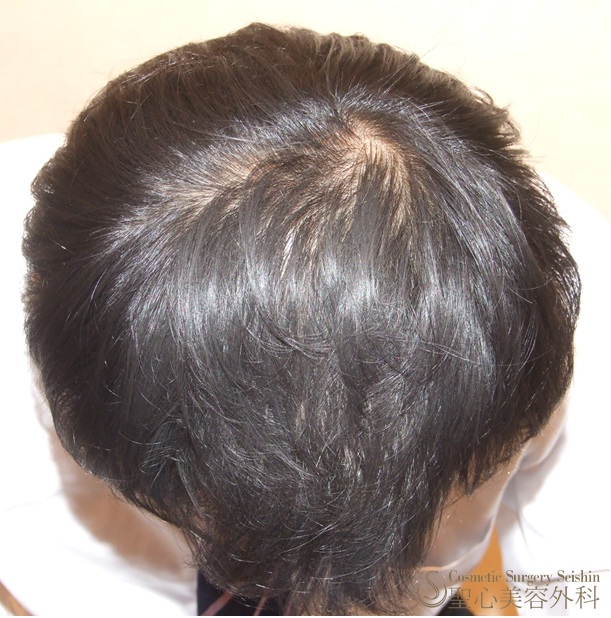 【30代男性：頭頂部の薄毛】グロースファクター再生療法+プロペシア+ロノテン+リアップX5 After 