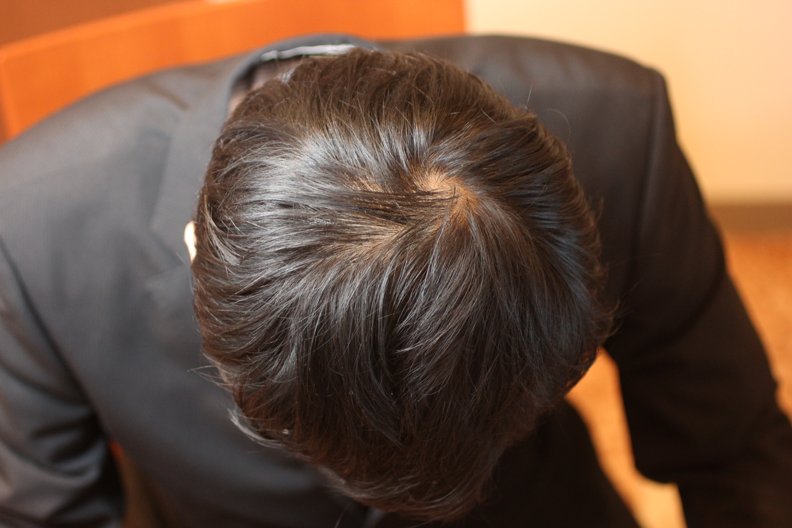 【30代男性：頭頂部の薄毛】グロースファクター再生療法+プロペシア+ロノテン+リアップX5 After 
