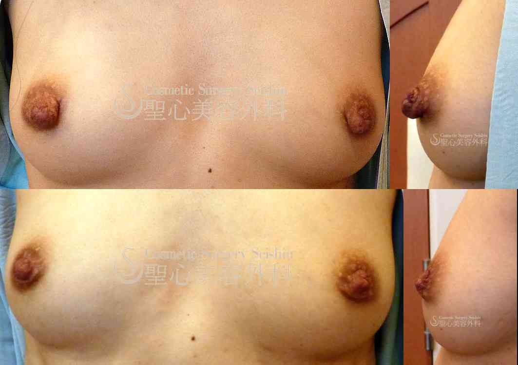 【30歳代：女性】　乳頭縮小 Before 