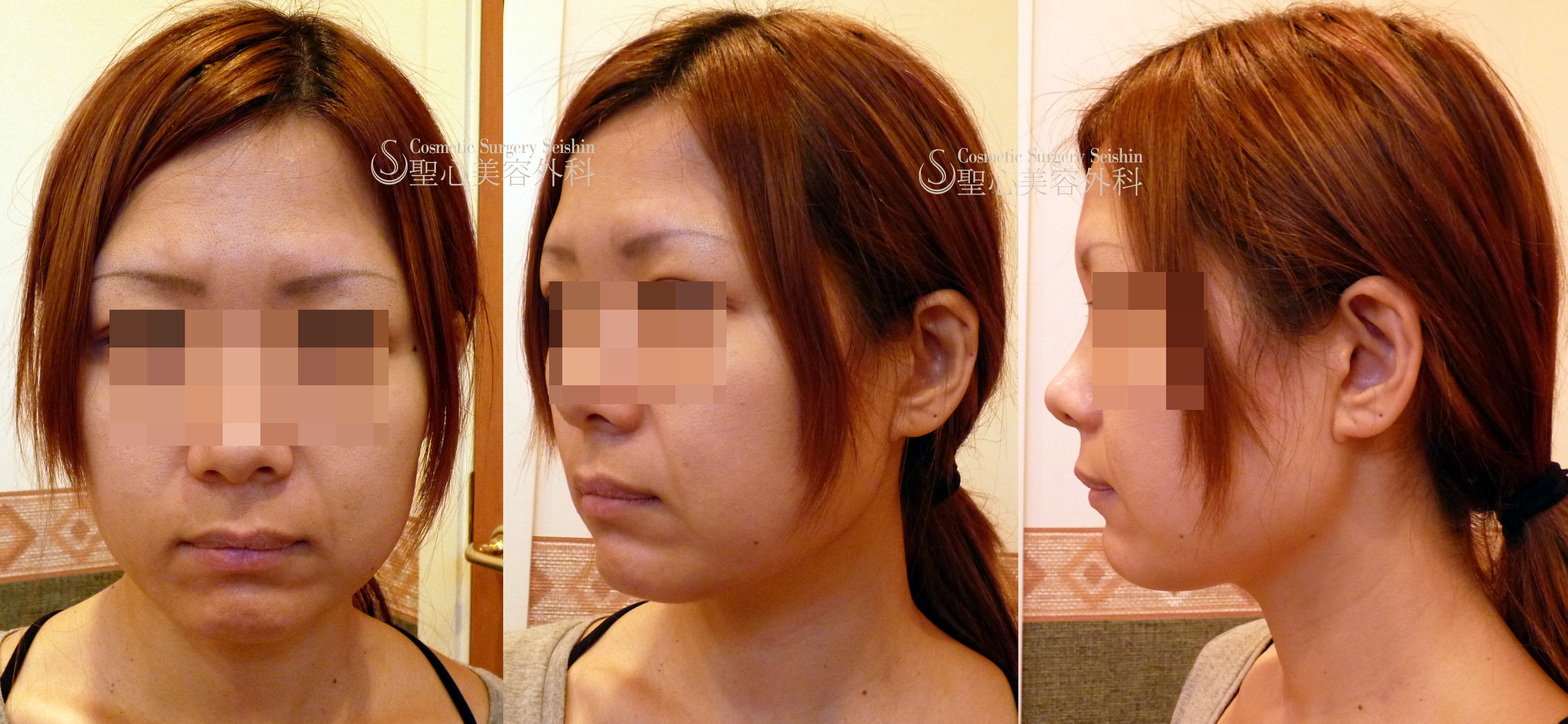【30代女性・頬の脂肪吸引】エルコーニアレーザー脂肪吸引（1ヶ月後） Before 