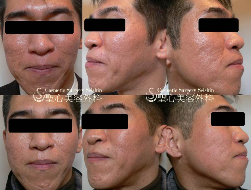 40代男性 にきび跡 イントラセル ニキビ跡のクレーター治療 症例写真 美容整形 美容外科なら聖心美容クリニック 40代男性 にきび跡 イントラセル ニキビ跡のクレーター治療 症例写真 美容整形 美容外科なら聖心美容クリニック