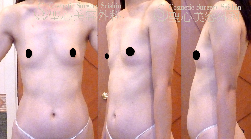 35歳女性：セリューション豊胸術（脂肪幹細胞注入） Before 