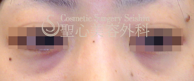 【27歳女性・目の下のクマ】プレミアムPRP皮膚再生療法（3ヶ月後） Before 