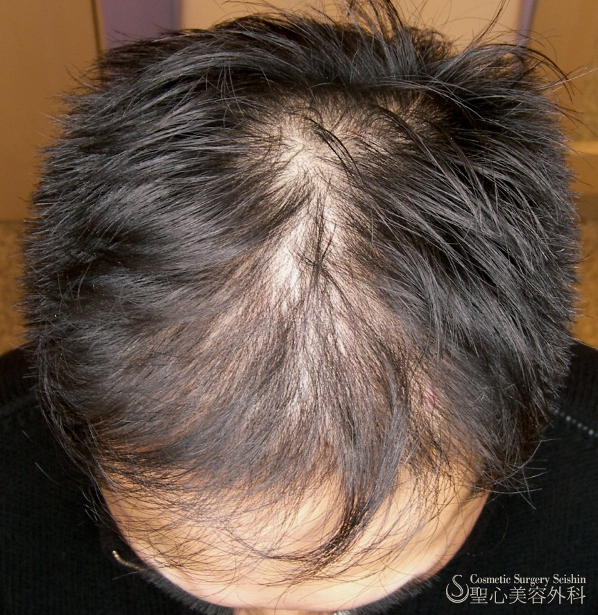 【40代男性・自毛植毛後】グロースファクター療法 Before 