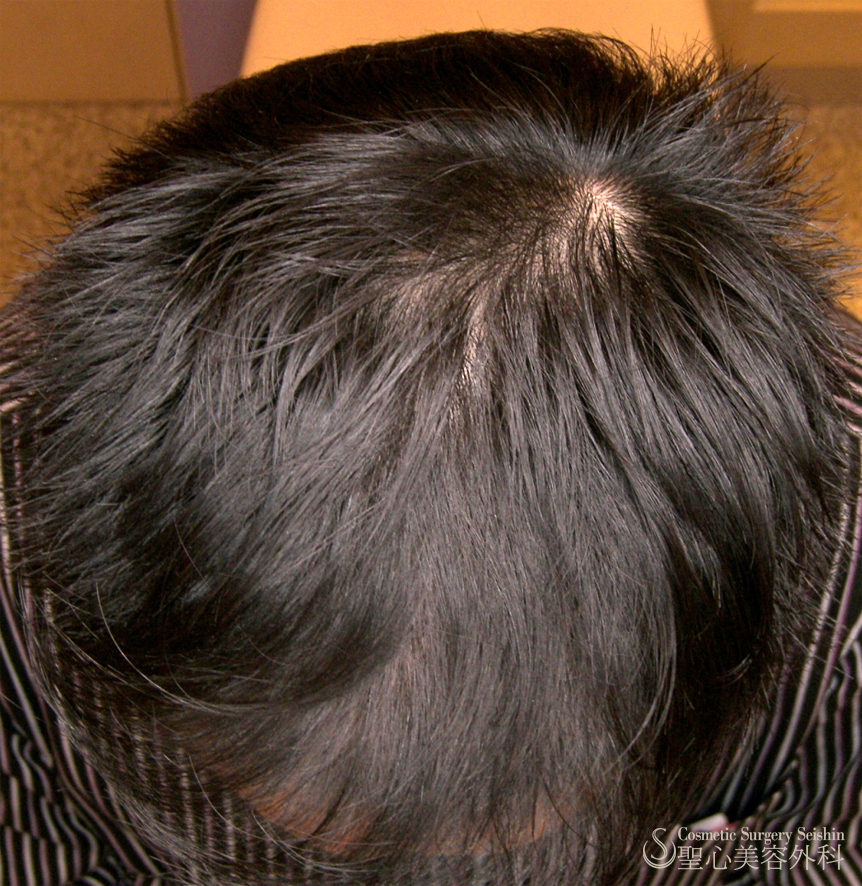 【40代男性・自毛植毛後】グロースファクター療法 After 
