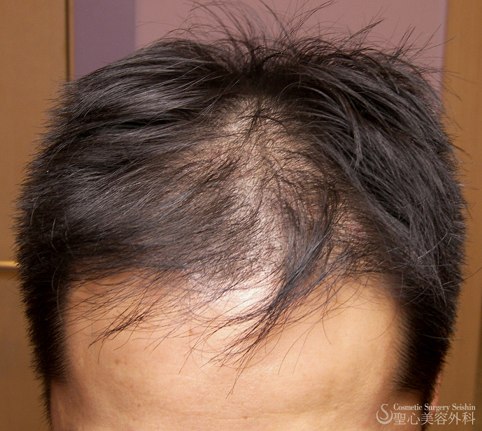 【40代男性・自毛植毛後】グロースファクター療法 Before 