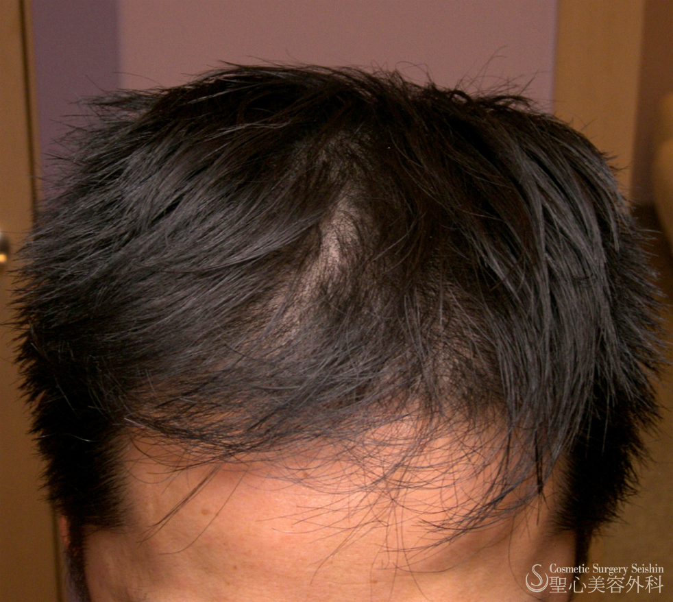 【40代男性・自毛植毛後】グロースファクター療法 After 