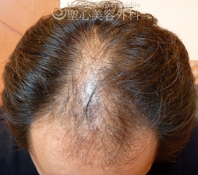 【30代男性・薄毛・AGA】グロースファクター再生療法（8回治療：6ヶ月後） Before 