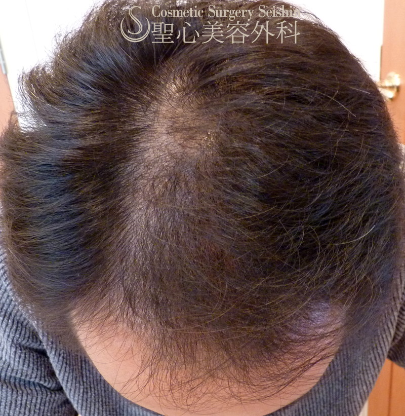 【30代男性・薄毛・AGA】グロースファクター再生療法（8回治療：6ヶ月後） After 