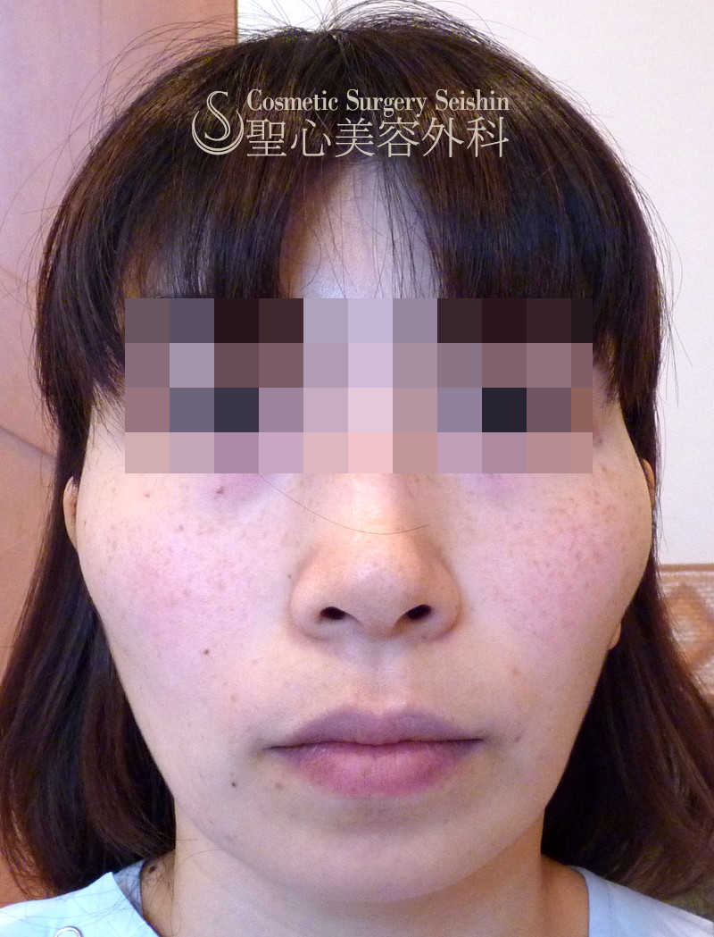 30代女性 頬のくぼみ 頬の脂肪注入 1ヶ月後 症例写真 美容整形 美容外科なら聖心美容クリニック