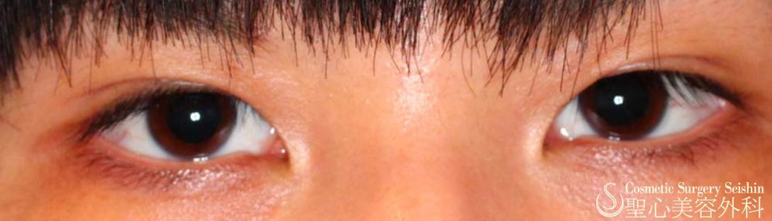 代女性 目頭切開 目は近づけたくない 症例写真 美容整形 美容外科なら聖心美容クリニック
