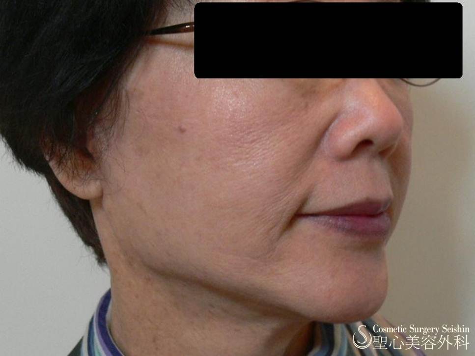 【70代女性：顔のたるみ】イントラセル Before 