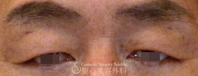 【40代男性・上まぶたの弛み取り】眉下切開法（4ヶ月後） Before 