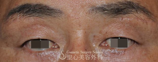 【40代男性・上まぶたの弛み取り】眉下切開法（4ヶ月後） After 