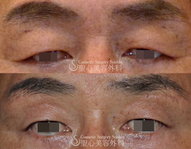 【40代男性・上まぶたの弛み取り】眉下切開法（4ヶ月後） After 