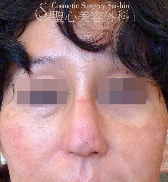【40代女性・鼻筋/鼻筋を全体的に細く】 鷲鼻修正（鼻骨骨切り）+ 鼻尖縮小（1ヶ月後） Before 