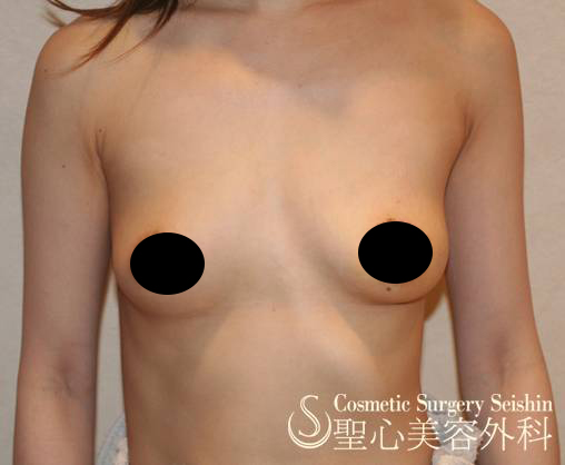 【30代女性・左右差をなくしたい】乳輪吊り上げ術（1週間後） After 
