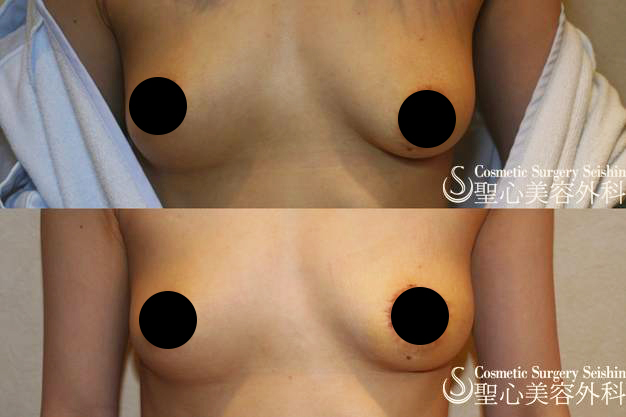 【30代女性・左右差をなくしたい】乳輪吊り上げ術（1週間後） After 