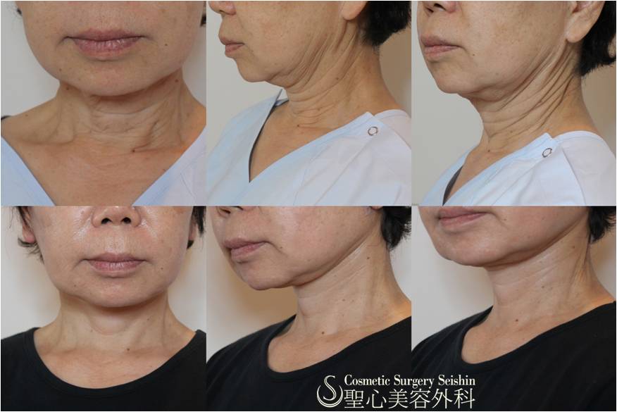【60代女性・首のたるみ取り】ネックリフト（施術直後） After 