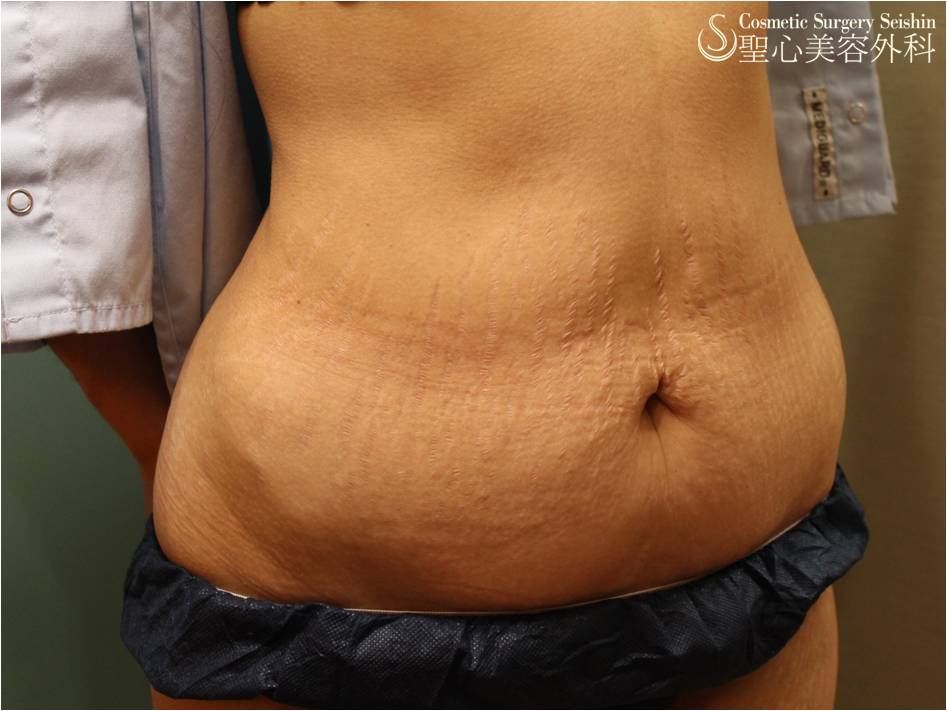 【30代女性・腹部の妊娠線】イントラセル Before 