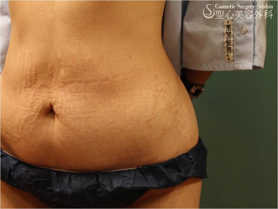 【30代女性・腹部の妊娠線】イントラセル Before 