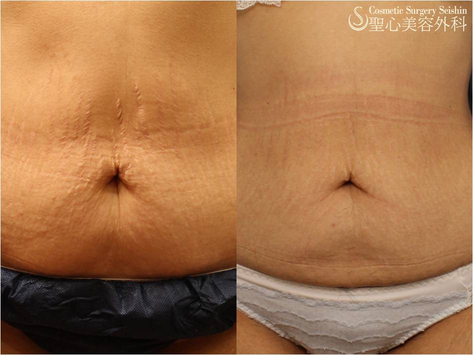 【30代女性・腹部の妊娠線】イントラセル Before 