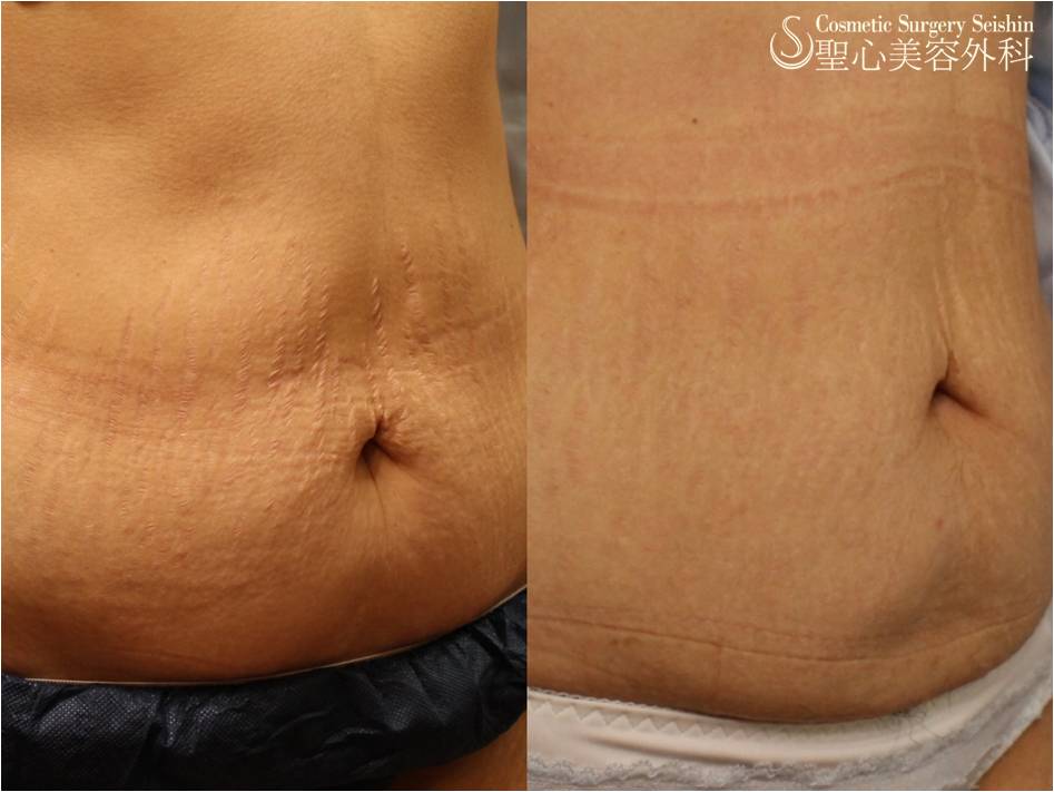 【30代女性・腹部の妊娠線】イントラセル After 