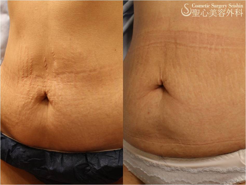 【30代女性・腹部の妊娠線】イントラセル After 