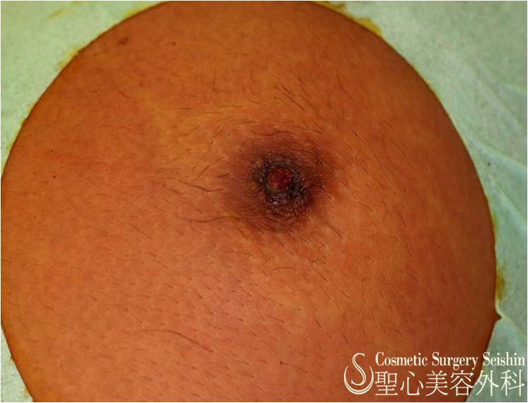 【30代男性　陥没乳頭】陥没乳頭修正術 After 