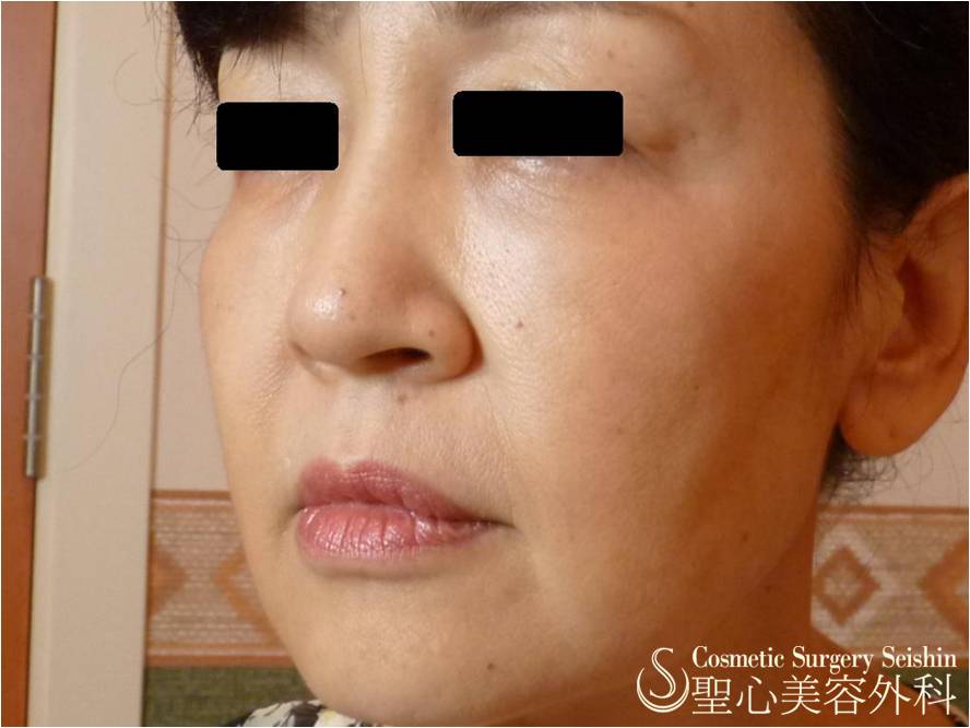 50代女性 目の下の若返り 経結膜脱脂 プレミアムprpの併用 1ヶ月後 症例写真 美容整形 美容外科なら聖心美容クリニック