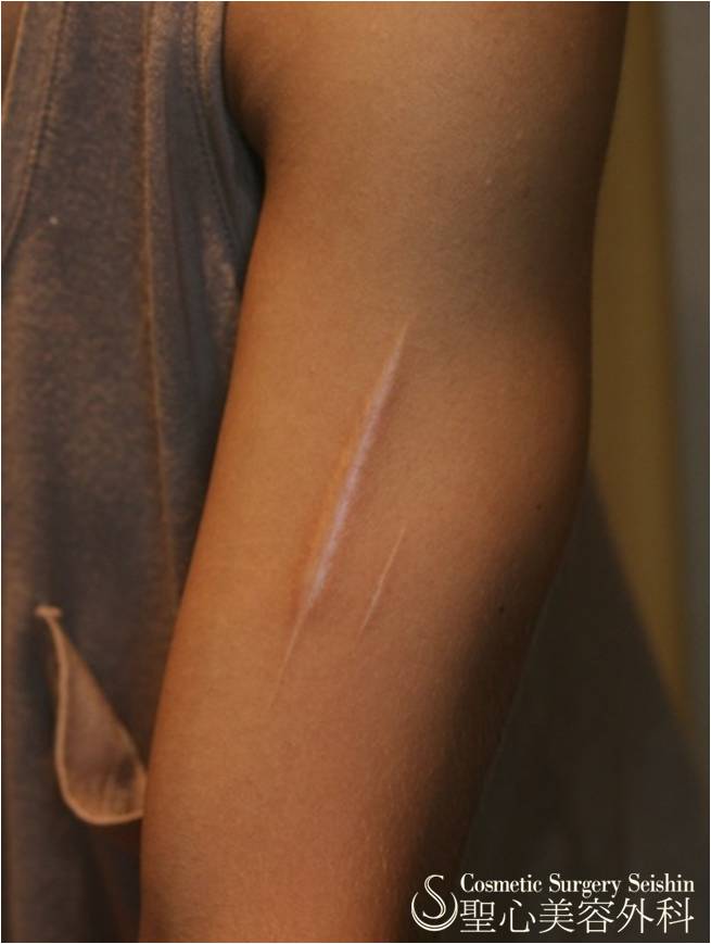 【30代女性・傷跡修正】肥厚性瘢痕除去（6ヶ月後） Before 