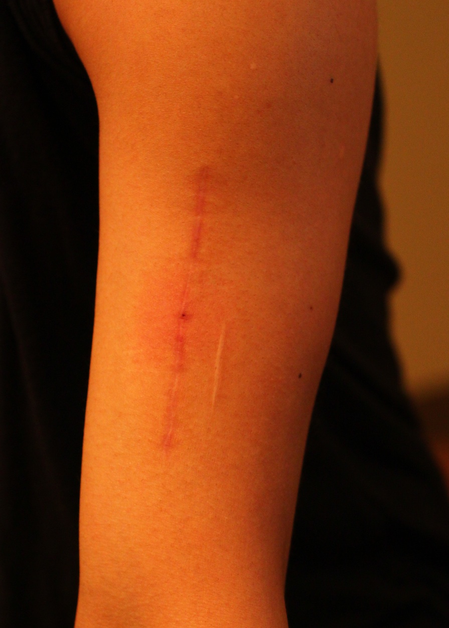 【30代女性・傷跡修正】肥厚性瘢痕除去（6ヶ月後） After 