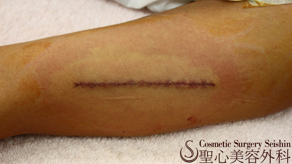 【30代女性・傷跡修正】肥厚性瘢痕除去（6ヶ月後） After 
