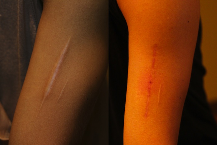 【30代女性・傷跡修正】肥厚性瘢痕除去（6ヶ月後） After 