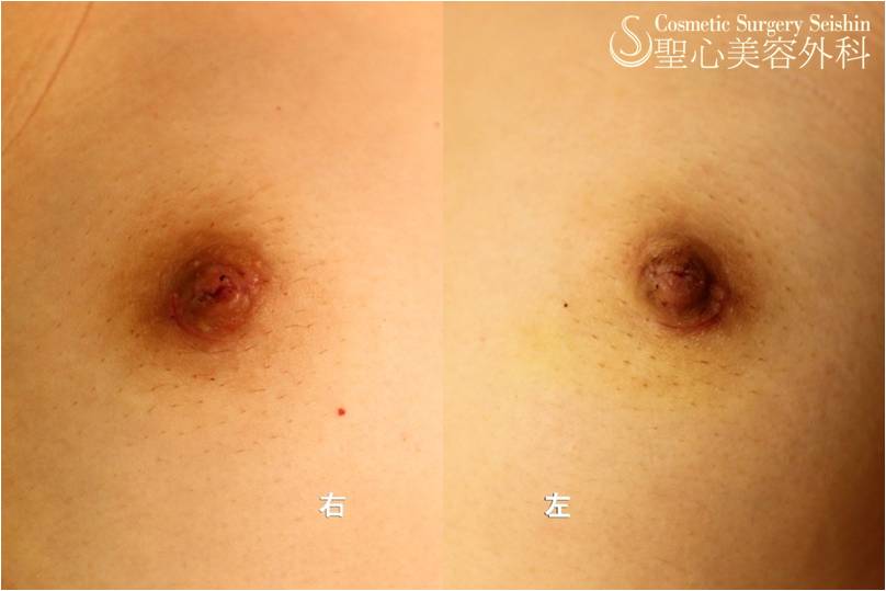 【10代女性　陥没乳頭】陥没乳頭修正術 After 