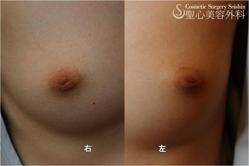 【10代女性　陥没乳頭】陥没乳頭修正術 Before 