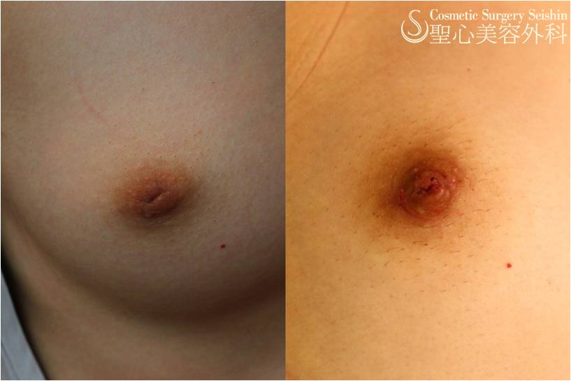 【10代女性　陥没乳頭】陥没乳頭修正術 After 