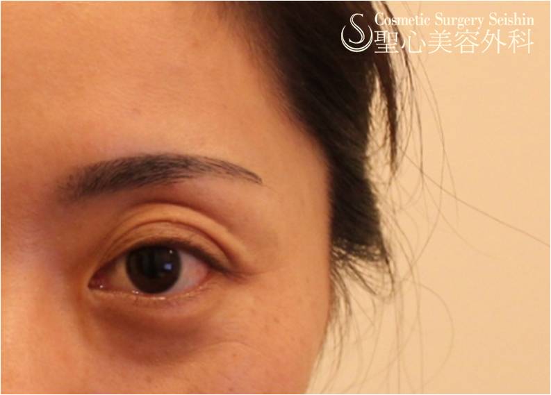 くぼみ目の改善 プレミアムprp 1ヶ月後 症例写真 美容整形 美容外科なら聖心美容クリニック