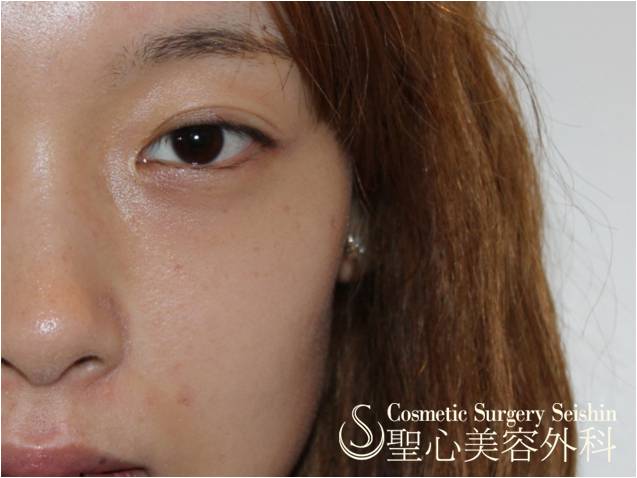 【20代女性・二重】眼瞼下垂（切開法）＋涙袋形成（1週間後と2ヶ月後） Before 