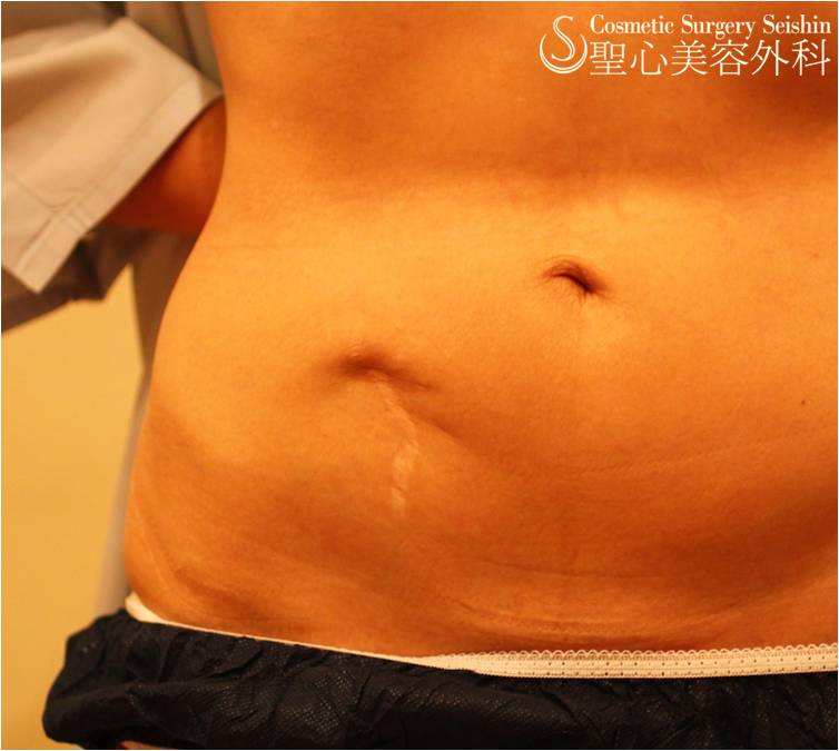 【50代女性・虫垂切除術後跡・妊娠線】 傷痕修正（1週間後） Before 